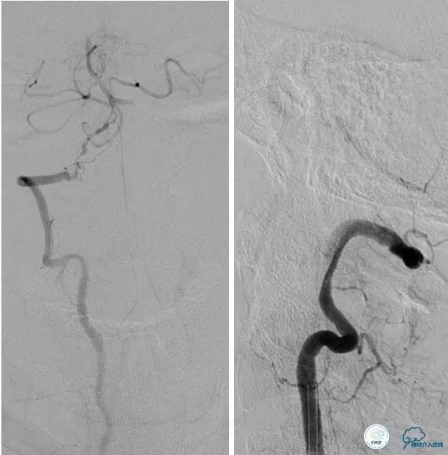 颅内动脉狭窄介入治疗研究,颅内血管cta副作用