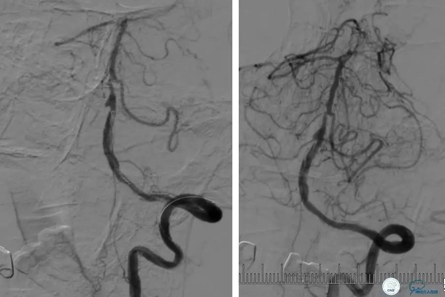 颅内动脉狭窄介入治疗研究,颅内血管cta副作用