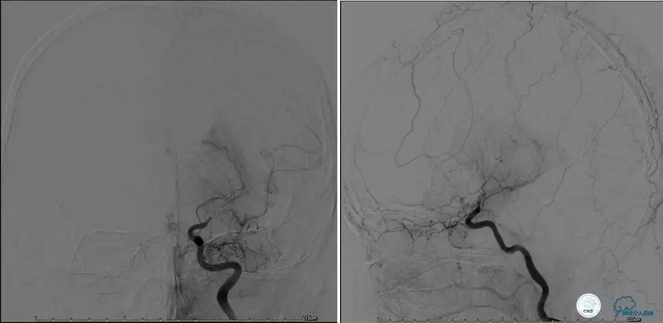颅内动脉狭窄介入治疗研究,颅内血管cta副作用