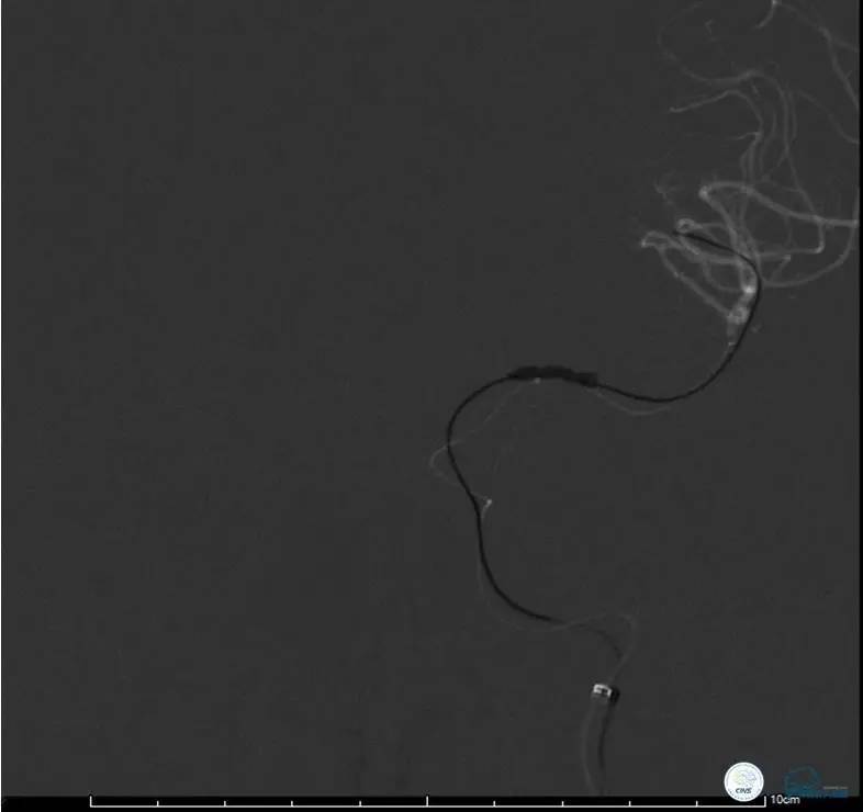 颅内动脉狭窄介入治疗研究,颅内血管cta副作用
