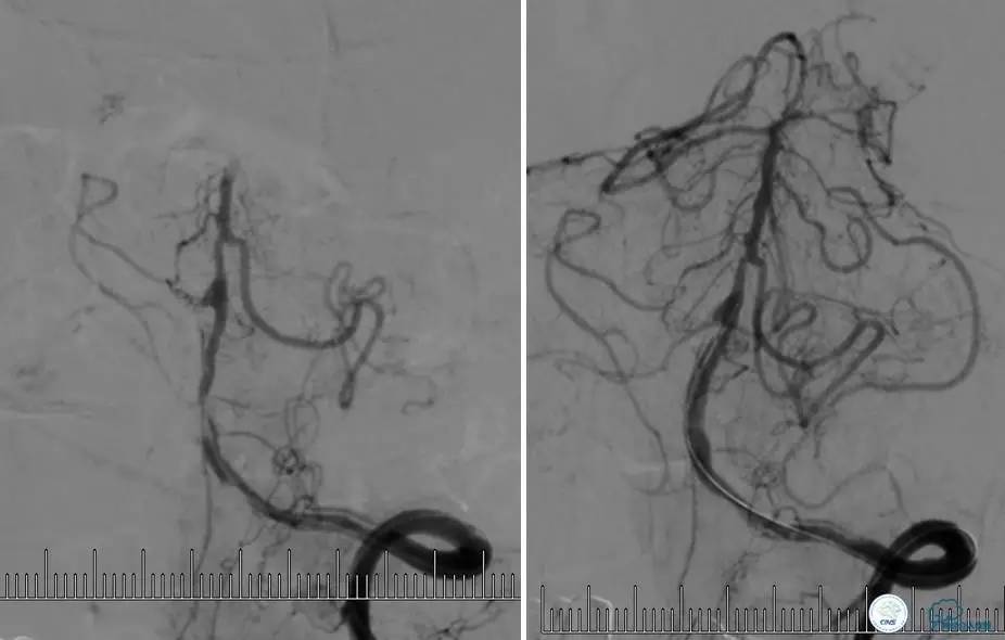 颅内动脉狭窄介入治疗研究,颅内血管cta副作用