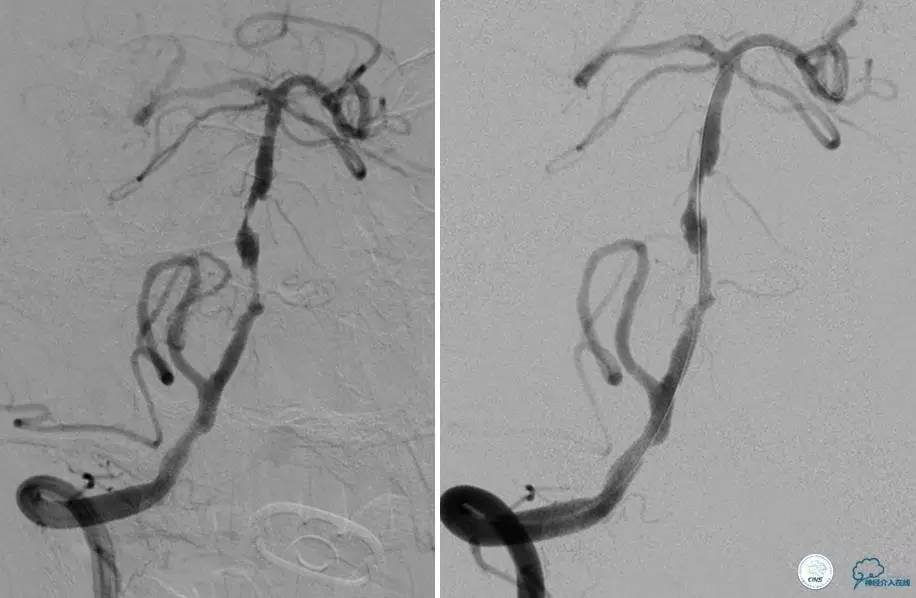颅内动脉狭窄介入治疗研究,颅内血管cta副作用