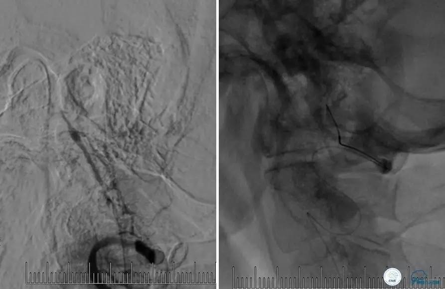 颅内动脉狭窄介入治疗研究,颅内血管cta副作用