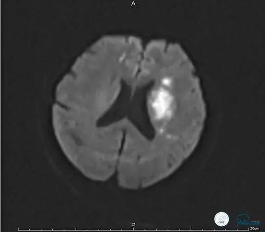 颅内动脉狭窄介入治疗研究,颅内血管cta副作用