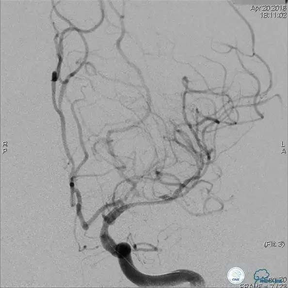 颅内动脉狭窄介入治疗研究,颅内血管cta副作用