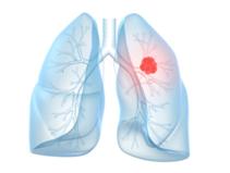 第三代肺癌靶向药阿法替尼,阿法替尼靶向药