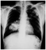 第三代肺癌靶向药阿法替尼,阿法替尼靶向药