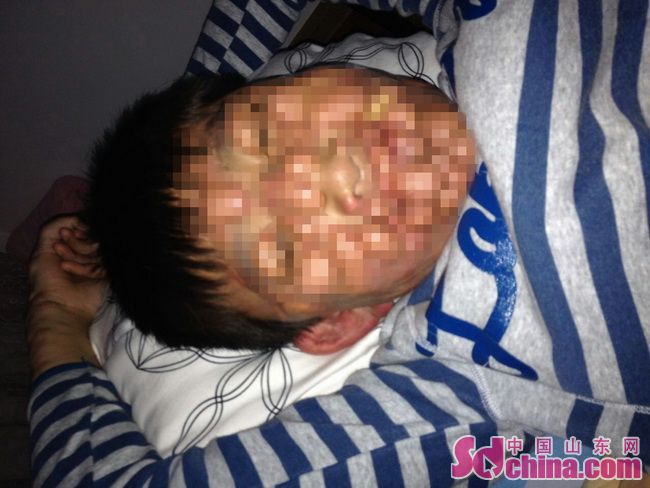 15岁男孩身患组织细胞肉瘤,小孩轻微恶性肉瘤能治好吗