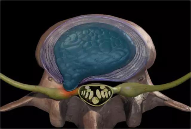 腰椎突出开刀手术要多久才能恢复,80%腰椎间盘突出症不需要手术