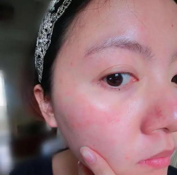 脸上长红色凸起小疙瘩,儿童脸上长小米粒疙瘩