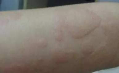 脸上长红色凸起小疙瘩,儿童脸上长小米粒疙瘩