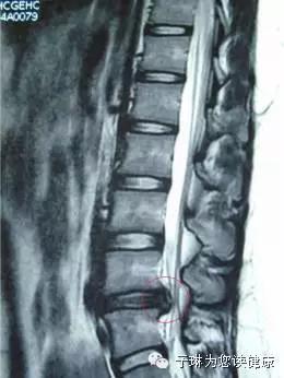 腰椎突出开刀手术要多久才能恢复,80%腰椎间盘突出症不需要手术