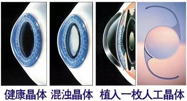 白内障可防可控吗,白内障如何预防和治疗