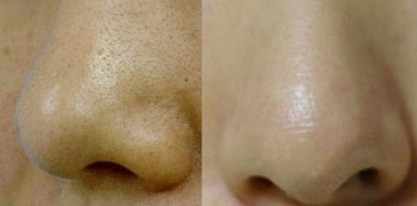 黑头鼻贴的正确贴法图,rnw黑头贴正确用法