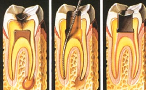 惊！根尖周病竟有这么大危害！中老年人成“重灾人群”！