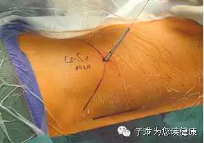 腰椎突出开刀手术要多久才能恢复,80%腰椎间盘突出症不需要手术