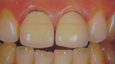 牙医为什么建议做二氧化锆,被牙医骗了的二氧化锆