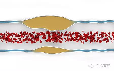 心血管软斑块危险,心血管软斑块和硬斑块的区别