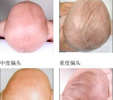 睡平头圆头,新生儿要睡圆头吗