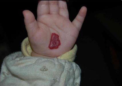 血管瘤和红斑区别,红色小斑是血管瘤吗