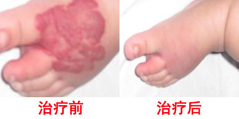 血管瘤和红斑区别,红色小斑是血管瘤吗