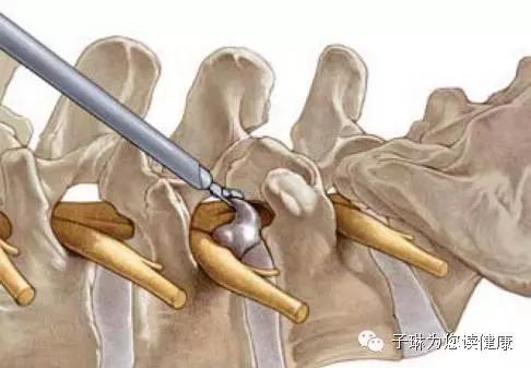 腰椎突出开刀手术要多久才能恢复,80%腰椎间盘突出症不需要手术