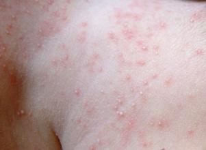 宝宝夏天怎么预防起痱子,夏季防止宝宝长痱子的秘诀