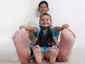 生长激素瘤是垂体瘤最严重的吗,生长激素性垂体瘤怎么治