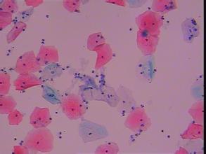念珠菌感染容易得宫颈癌吗,念珠菌食管炎是癌症吗能治好吗