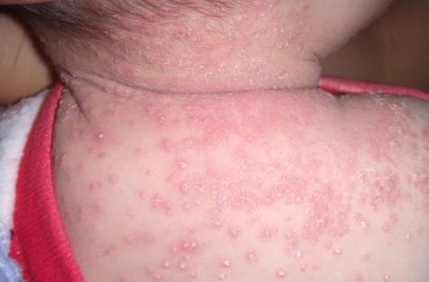 7个月宝宝快速祛痱子,宝宝热痱子快速去掉小妙招