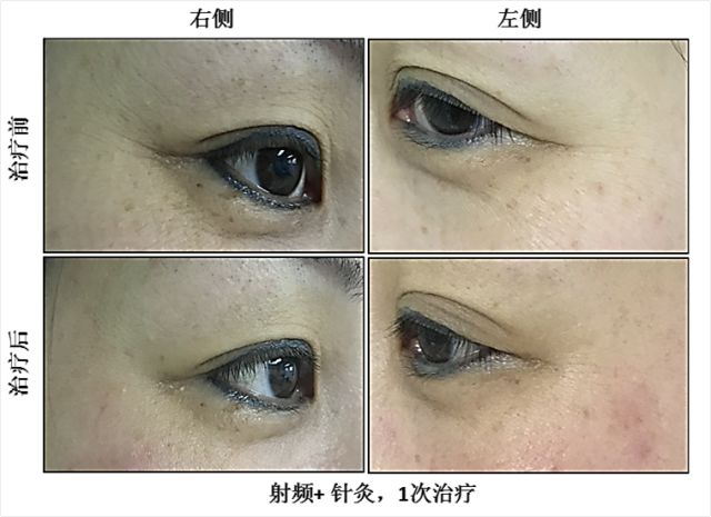 延缓衰老最好的针,针灸治疗抗衰老的教学视频