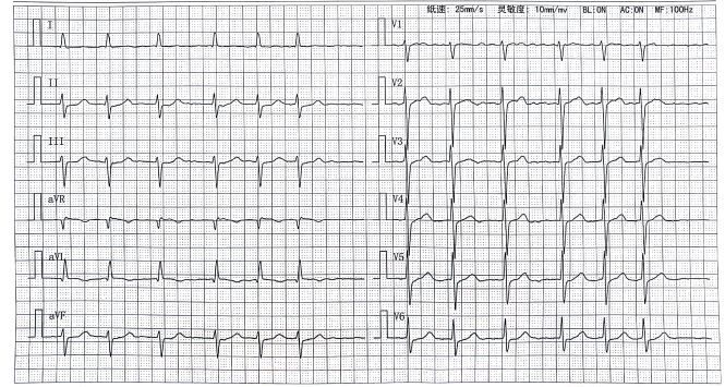 「病例帮」房颤合并冠心病患者抗栓策略之一：当房颤遇上ACS