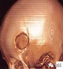 3岁小孩头上有个包做ct说是骨瘤,小孩头部ct为什么会增加肿瘤几率