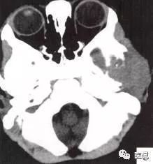 3岁小孩头上有个包做ct说是骨瘤,小孩头部ct为什么会增加肿瘤几率