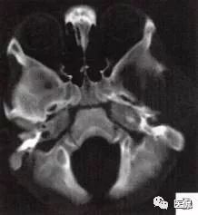 3岁小孩头上有个包做ct说是骨瘤,小孩头部ct为什么会增加肿瘤几率