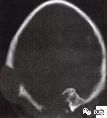 3岁小孩头上有个包做ct说是骨瘤,小孩头部ct为什么会增加肿瘤几率