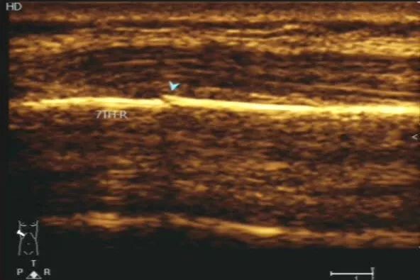 超声提示不发育了怎么回事呢,超声检查不硬咋办