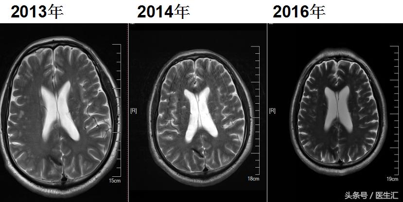 进行性核上性麻痹综合征,进行性核上性麻痹存活寿命