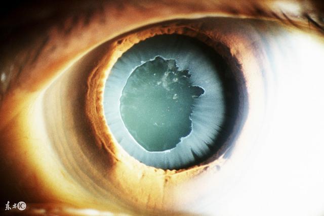 醋甲唑胺片治青光眼的原理,醋甲唑胺对青光眼有治疗的功效吗