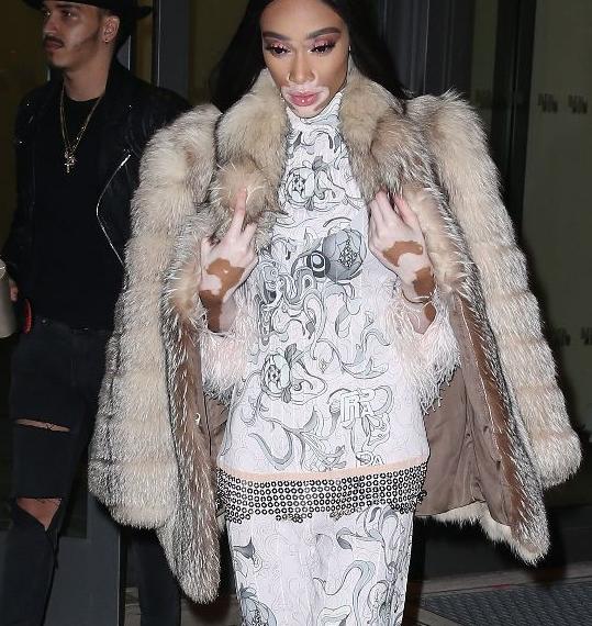 全世界公认的超模,最漂亮的白癜风超模