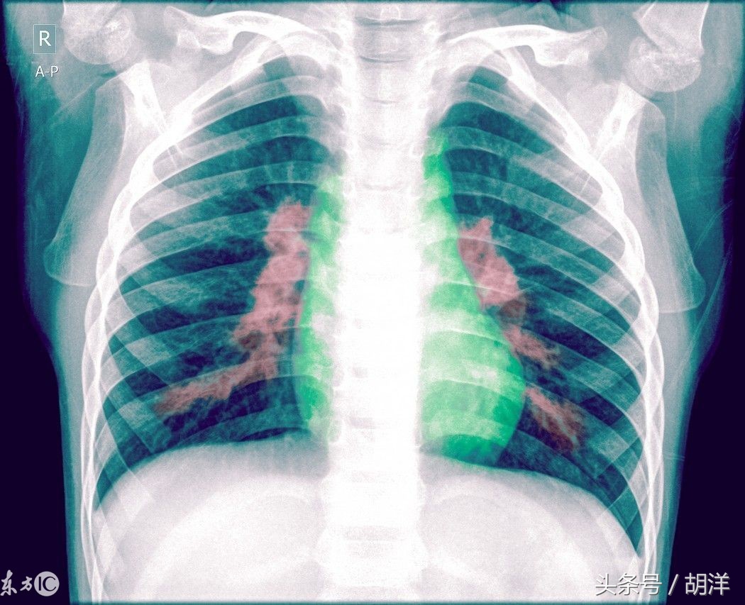 肺炎所致的感染性休克应视察什么,肺炎一定会出现的症状