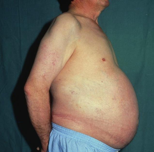 肝区主任：这个坏习惯惯的！销售总监年仅27岁得肝癌晚期