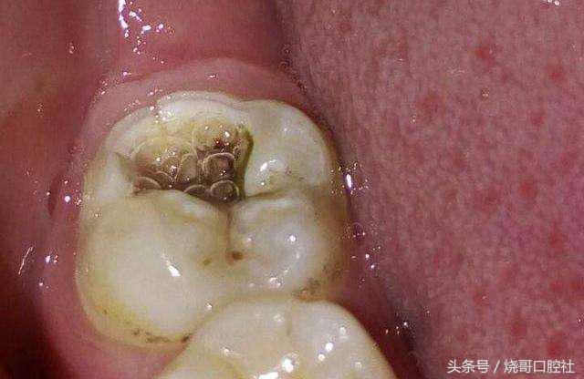 烂牙发黑是不是牙神经病变了？