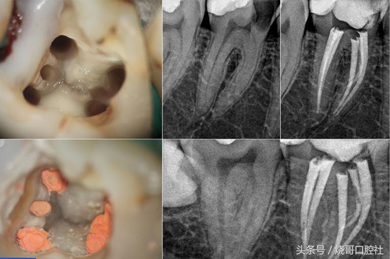烂牙发黑是不是牙神经病变了？