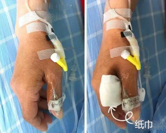 输液扎针最全最新示范,扎针输液的示范