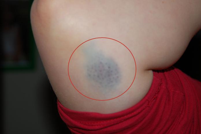 人为什么磕碰一下就淤青了,没磕没碰身上出现淤青民间说法