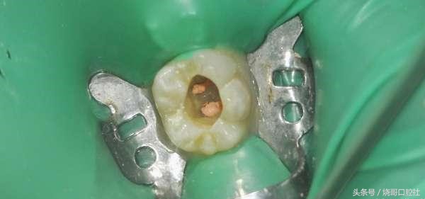 烂牙发黑是不是牙神经病变了？