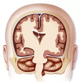 轻脑梗治疗方案,急性脑中风的症状