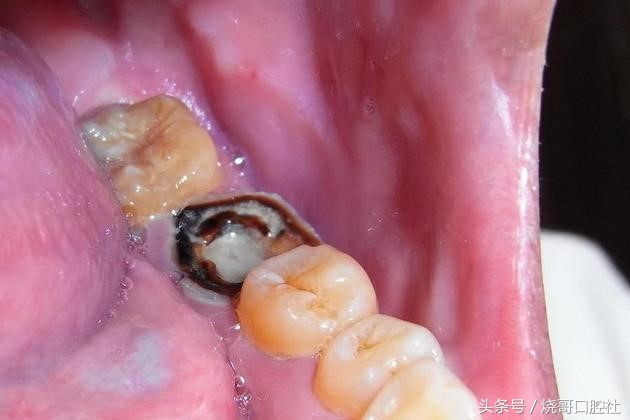 烂牙发黑是不是牙神经病变了？