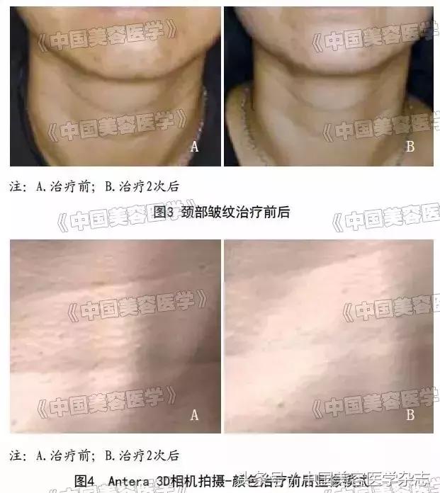 颈纹很深怎么办二十岁,玻尿酸可以祛除颈纹吗